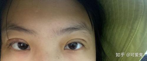 割双眼皮过程视频,从术前准备到术后恢复