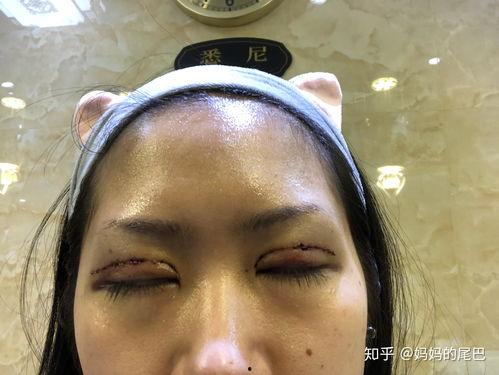 割双眼皮过程视频,从术前准备到术后恢复