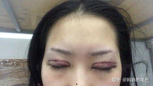 割双眼皮过程视频,从术前准备到术后恢复