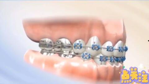 牙齿矫正的视频,跟随视频见证美丽蜕变