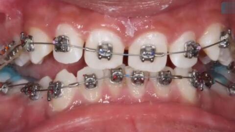 牙齿矫正的视频,跟随视频见证美丽蜕变