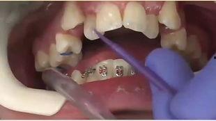 牙齿矫正的视频,跟随视频见证美丽蜕变