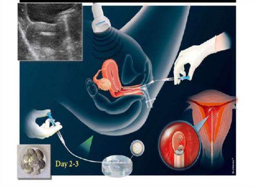 胚胎移植视频,从培育到移植的神奇之旅