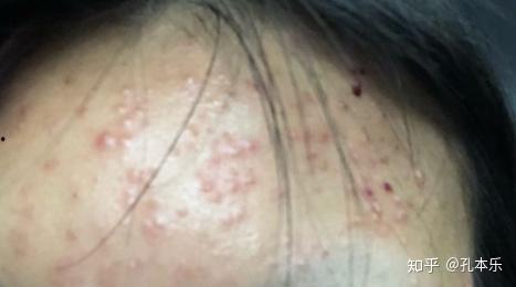 毛囊炎视频,视频揭秘病因、症状及防治方法