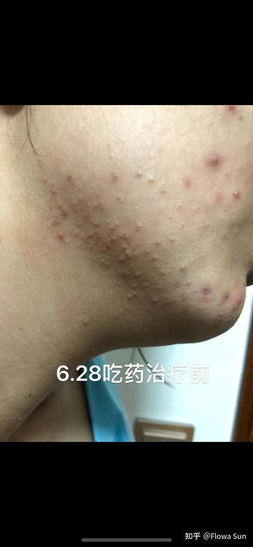 毛囊炎视频,视频揭秘病因、症状及防治方法