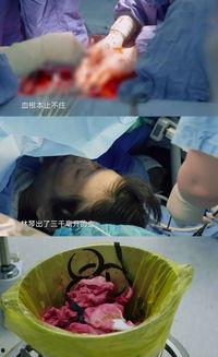孕妇剖腹产视频,孕妇分娩的另一种选择