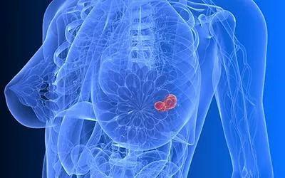 乳房有硬块图片大全,常见类型及自我检查指南