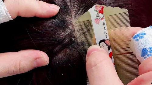 刮头皮屑视频,跟随视频探索头皮屑的成因与防治