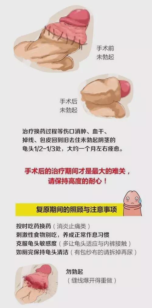 包皮手术全过程视频,从术前准备到术后恢复