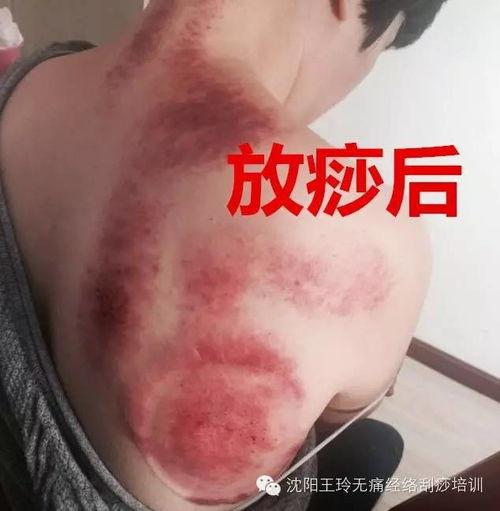 揪痧 视频,传统养生新视角